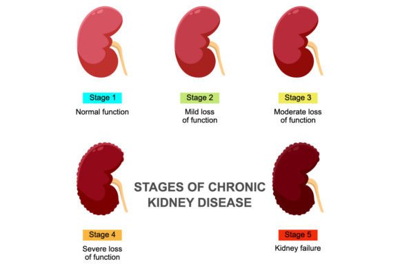 Stages of Chronic Kidney Disease Graphics